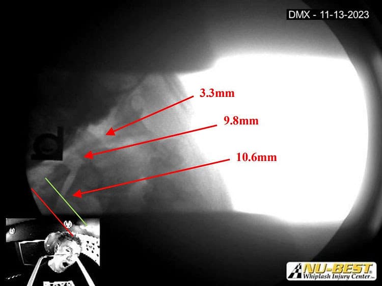 Digital Motion X-Rays In Motorcycle Accident Injury Victims